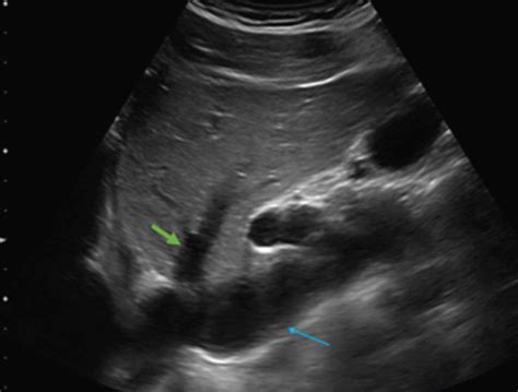 IVC on right upper quadrant ultrasound. Visualization of the hepatic ...