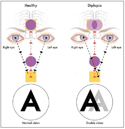 Lesson: UNRAVELING AMBLYOPIA, STRABISMUS, PHORIAS AND TROPIAS