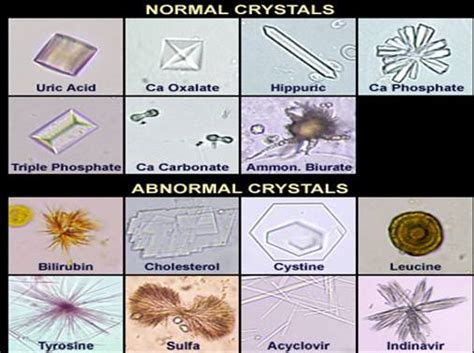 Tipos de Cristais na Urina | Association LEA