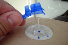 Infusion Set Insertion - Diabetes Education Online