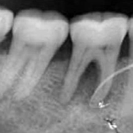 (PDF) A sequential approach in treatment of perio-endo lesion