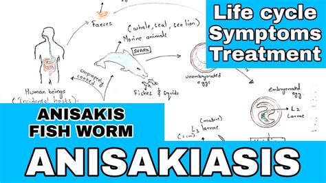 Anisakiasis Anisakis Life Cycle Symptoms Treatment By Phanindra – Otosection