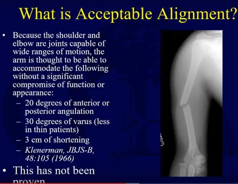 Humeral shaft fractures: Indications for Operative treatment Vs ...