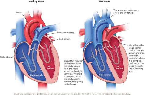 Congenital Heart Defects Dextro-Transposition Of The Great, 41% OFF