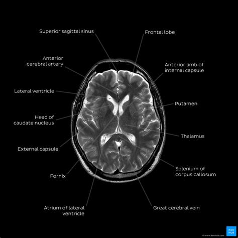 How To Read A Mri Of Brain Brain Anatomy Mri Explained In English | The Best Porn Website