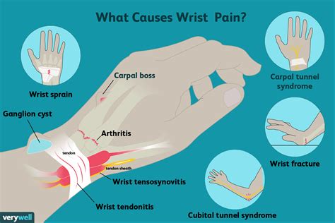 Wrist Pain: Causes, Symptoms, and Treatment