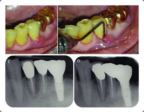 (A) Clinical image showing buccal swelling related to tooth #34. (B ...