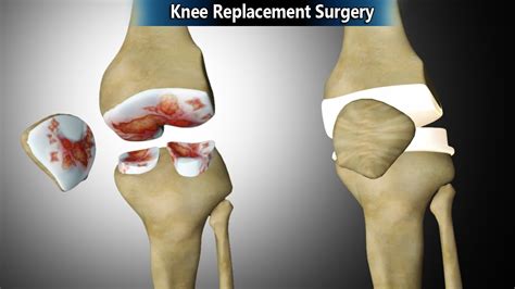 Knee Replacement Animation / JOURNEY UNI Surgical Animation - Smith ...