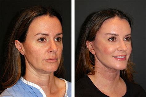 Facelift Before and After