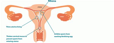 Bleeding After Mirena Removal – What You Should Know | Hirharang