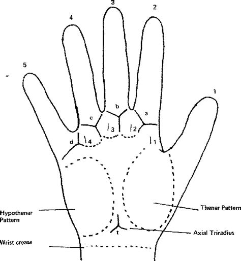 Figure 2 from Dermatoglyphics of Congenital Abnormalities without ...