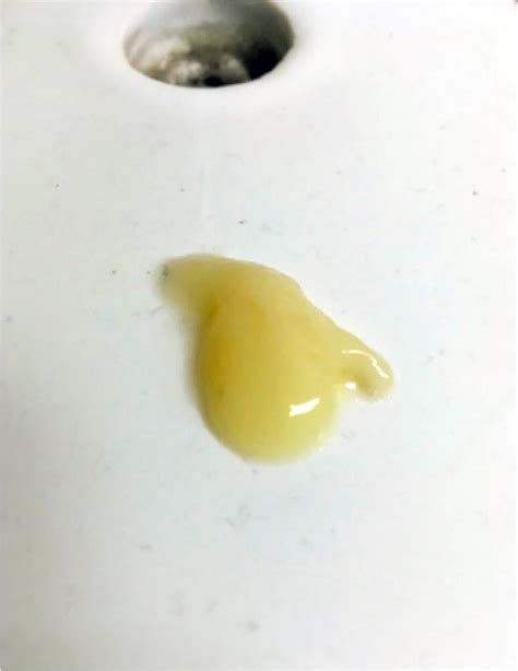 Picture of a drop of the patient’s urine shows a thick viscous yellow ...