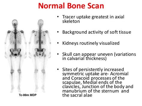 Bone scan in Orthopaedics