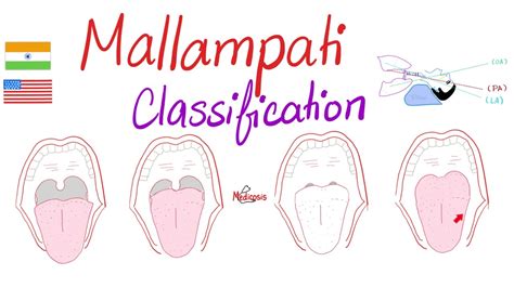 Mallampati Score (Classification) for Airway Management - YouTube