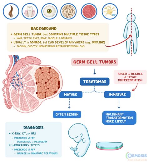 Teratoma: What Is It, Signs, Symptoms, and More | Osmosis