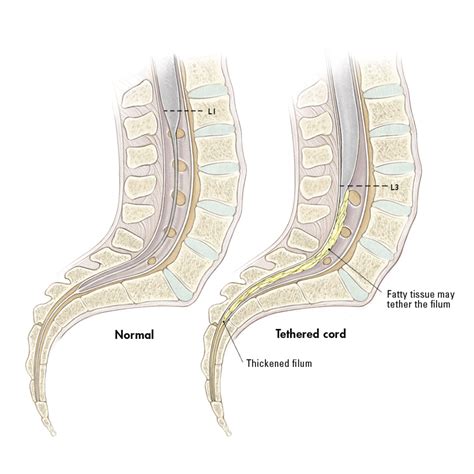 Tethered Spinal Cord Syndrome: What You Need To Know? - HubPages