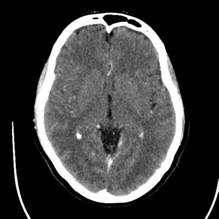 Normal CT brain | Radiology Case | Radiopaedia.org