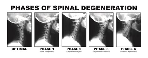 Living With A Spinal Misalignment - Straight Spine Chiropractic Courtenay and Campbell River