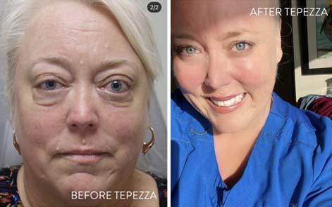 What is Tepezza? | Tepezza TED - Thyroid Eyes Treatment