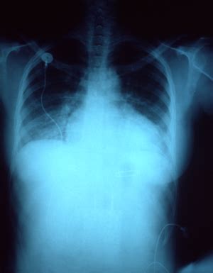 Symptoms of Chest Congestion