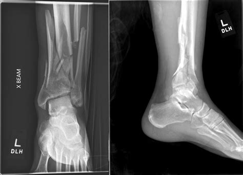 Pilon Fracture Article