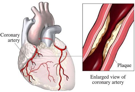 Coronary Artery