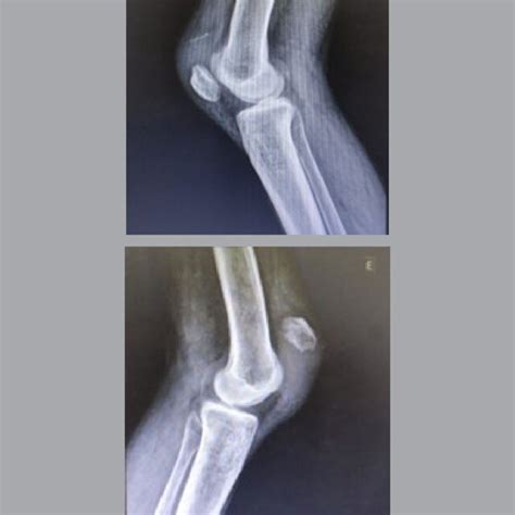 Radiographs showing patella baja on the right knee, with a... | Download Scientific Diagram