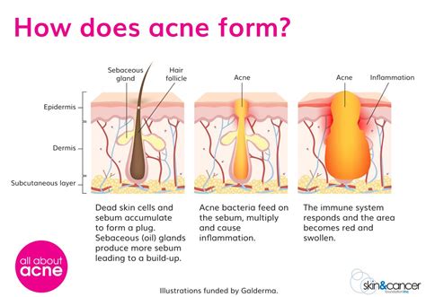 What Causes Acne - Acne Causes - All About Acne