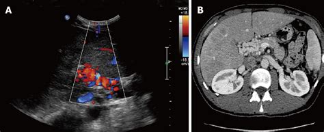 Portal Vein Thrombosis Ultrasound