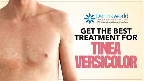 Tinea Versicolor Treatment