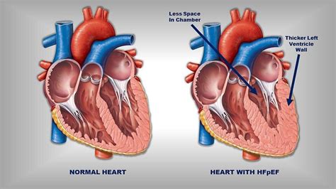 Obesity weakens heart muscle in patients with a common type of heart failure