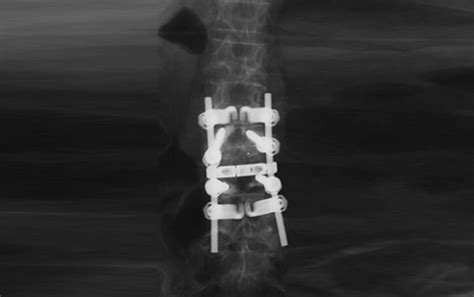 What is Lumbar Spinal Fusion? | Premia Spine