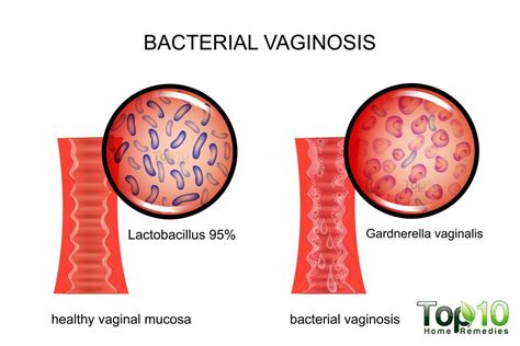 Home Remedies for Bacterial Vaginosis | Top 10 Home Remedies