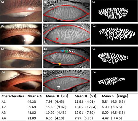 Meibomian Gland Clogged