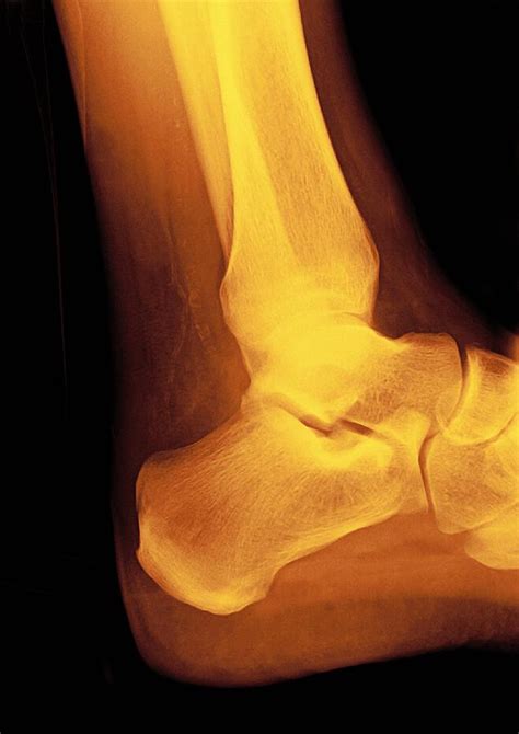 Normal Ankle Joint, X-ray Photograph by Miriam Maslo - Fine Art America