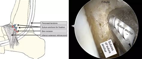 Arthroscopic modified Brostrom operation allows faster recovery in chronic ankle instability