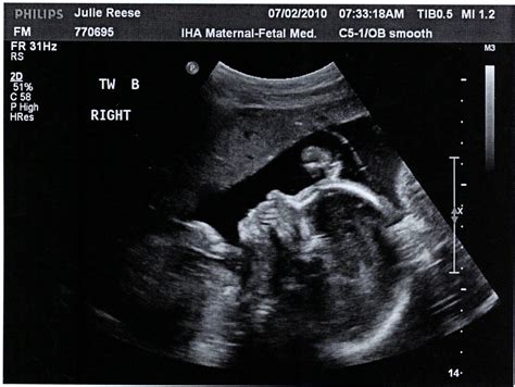 Reese Adventures: Week 26 Ultrasounds