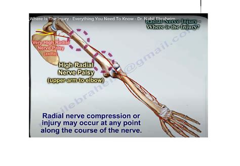 How to localise Radial Nerve Injury? — OrthopaedicPrinciples.com