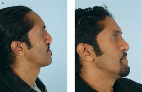 Lengthening the Short Nose | Plastic Surgery Key