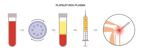 Platelet Rich Plasma (PRP) Injections | Steroid Injections London