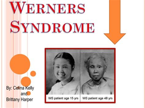 Werners Syndrome | PPT