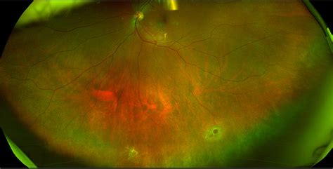 Atrophic Retinal Hole