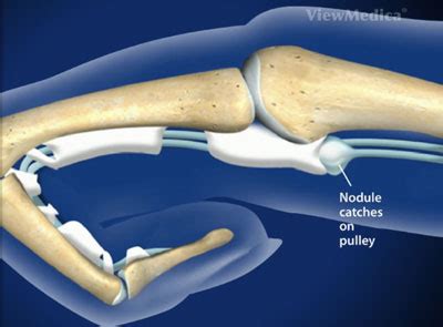 Trigger Finger Surgery Los Angeles, Trigger Finger Surgeon, Specialist