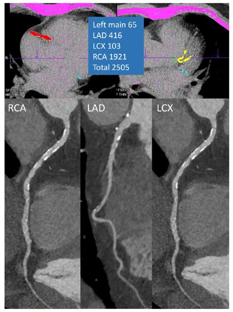 Excellent image quality in a patient with a very high CAC score. | Download Scientific Diagram