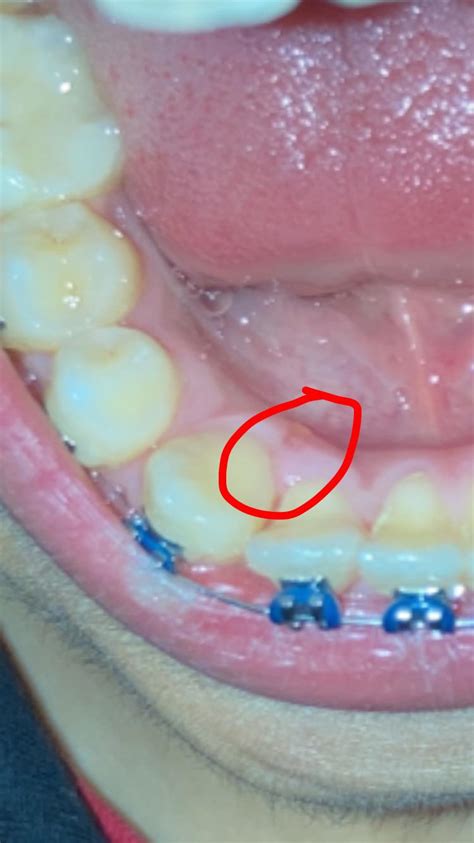 hi, i just got this little gum bump behind my teeth , should I be worried ? would it go away on ...