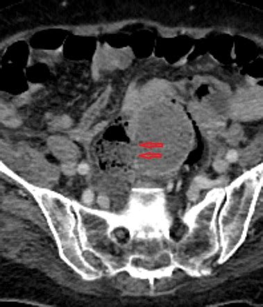 Stercoral perforation - sigmoid colon | Image | Radiopaedia.org