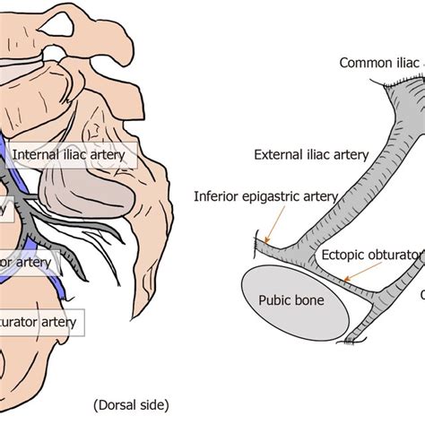 Relation between myopectineal orifice and all hernias (direct inguinal ...