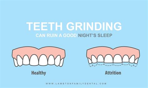 The Nightly Grind: Teeth Grinding Causes, Risks, Cures for Bruxism | Lambton Family Dental