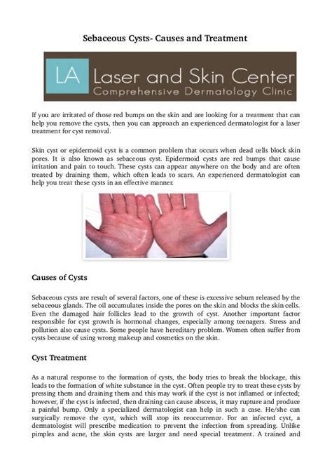 Sebaceous cysts causes and treatment