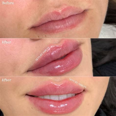 Best of Cosmetic Dermatology on Instagram: “Before/after lip filler ...